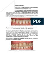 Carillas Dentales en Cerámica Feldespática