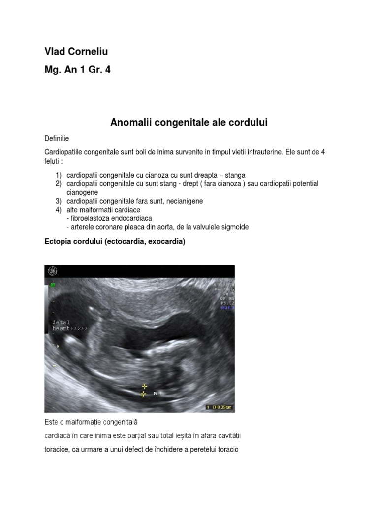 Anomalii Congenitale Ale Cordului | PDF