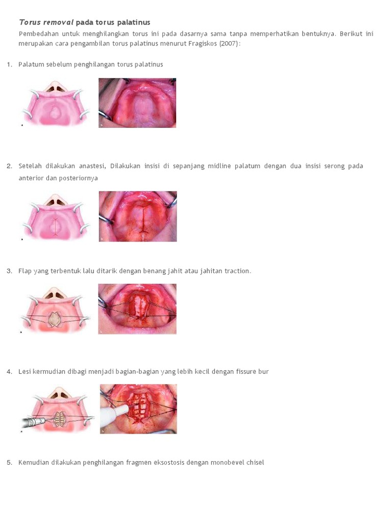 Torus Removal | PDF