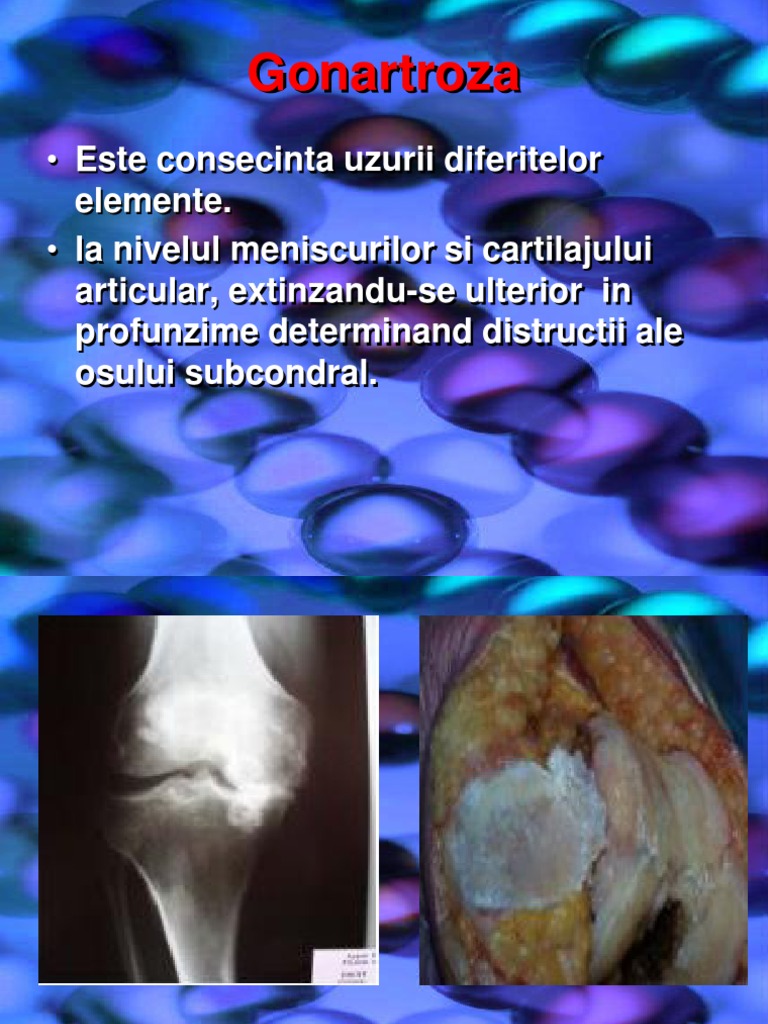 Gonartroza Master | PDF