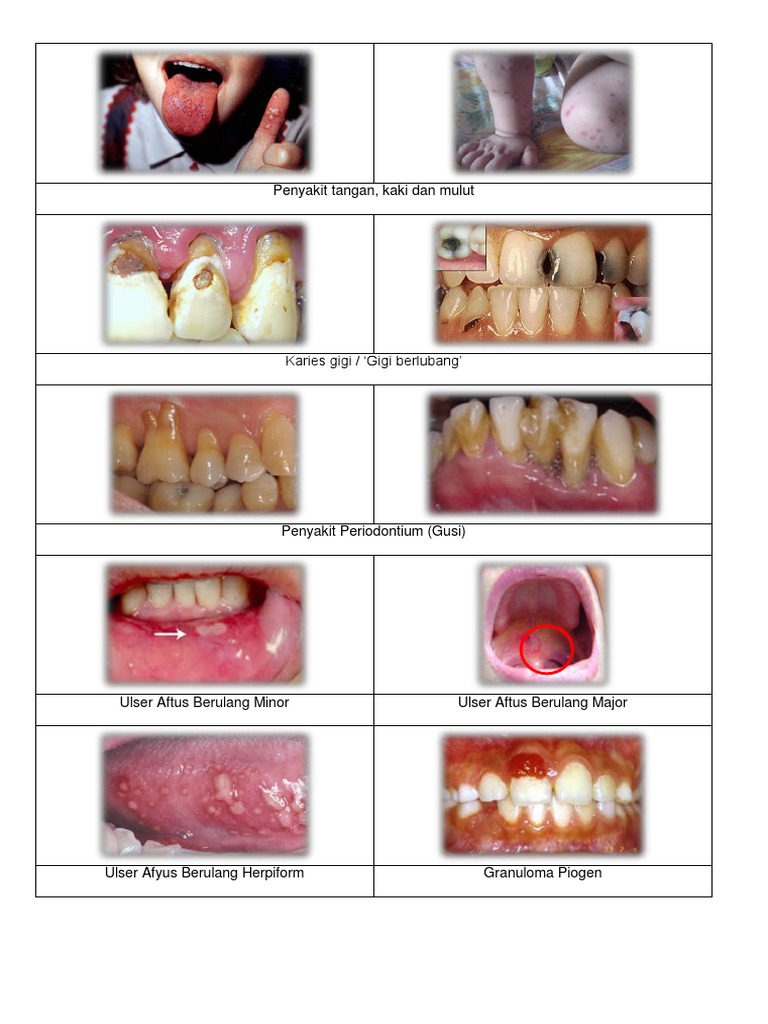 Gambar Penyakit Mulut Pdf