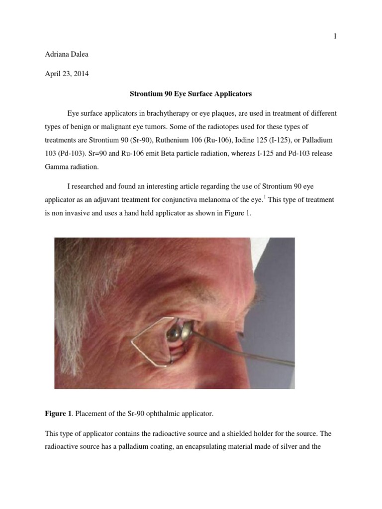 eye surface applicators-sr-90 | Radiation Therapy | Melanoma