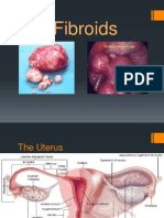 Fibroids Powerpoint