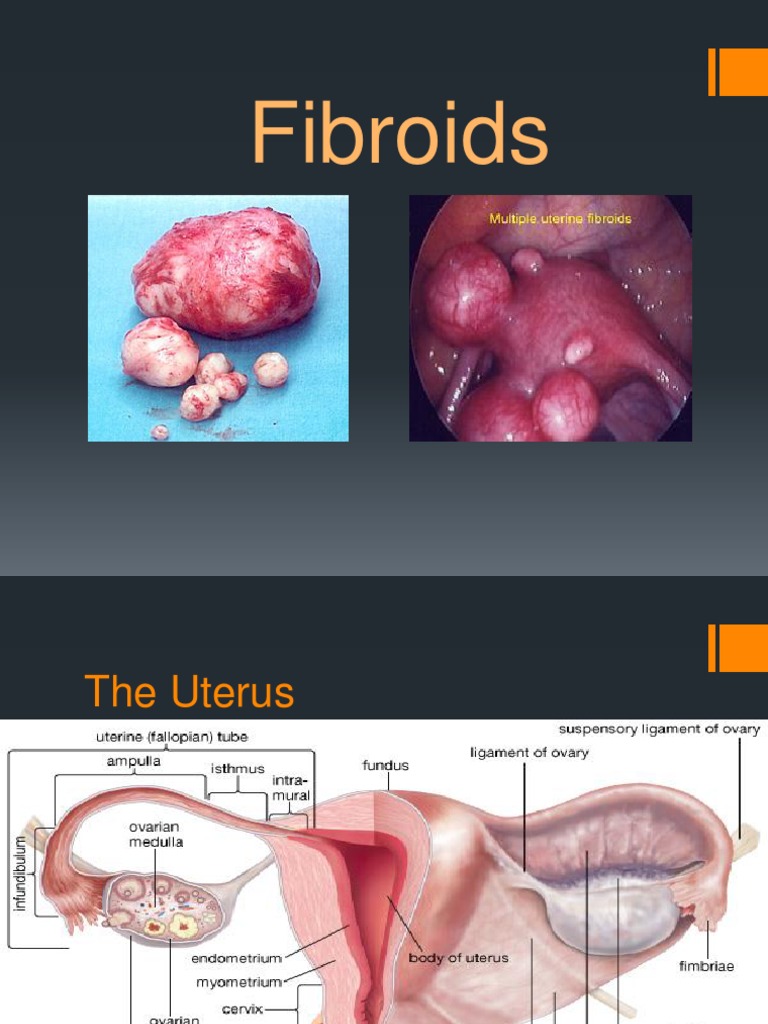 Do fibroids affect fertility and IVF outcome?, image size:768x1024