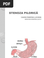 Stenoza Pilorica