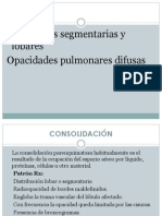 Consolidacion Pulmonar