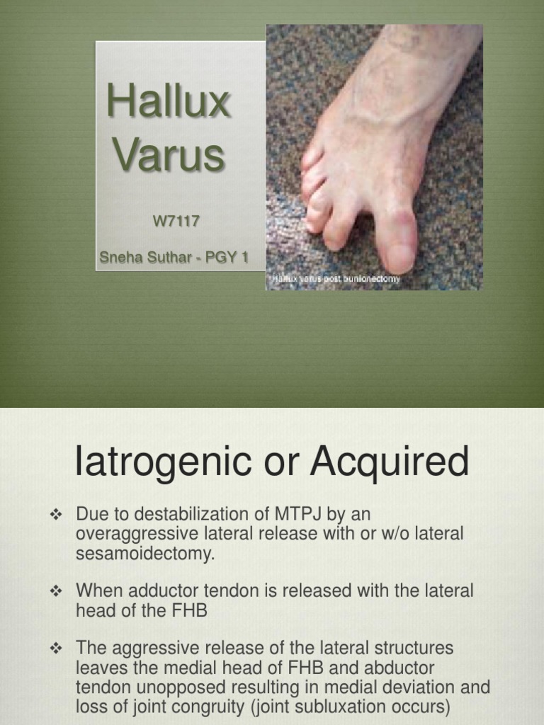 Hallux Varus Toe Anatomical Terms Of Motion