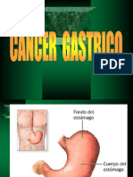 Cáncer Gástrico