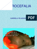 hidrocefalia