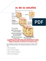 Fases de La Celulitis y Tratamiento