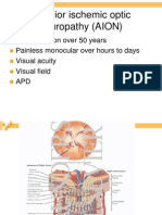 AION Anterior Ischemic Optic Neuropathy AION