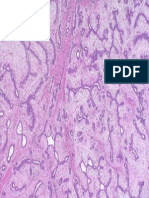 Fibroadenoma Breast 3