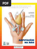 Amputações Na Mão
