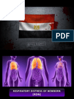 Respiratory Distress Syndrome (HMD) MO