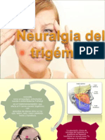 Neuralgia Del Trigemino