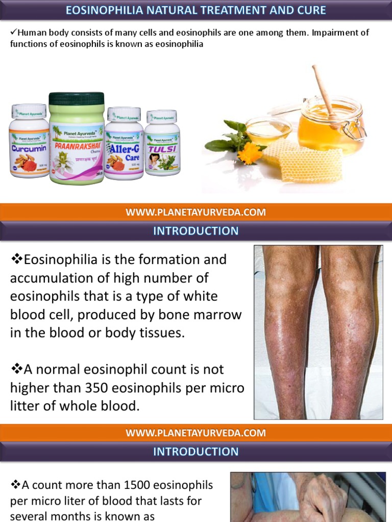 Natural Treatment for Eosinophilia & Cure Allergy Clinical Medicine