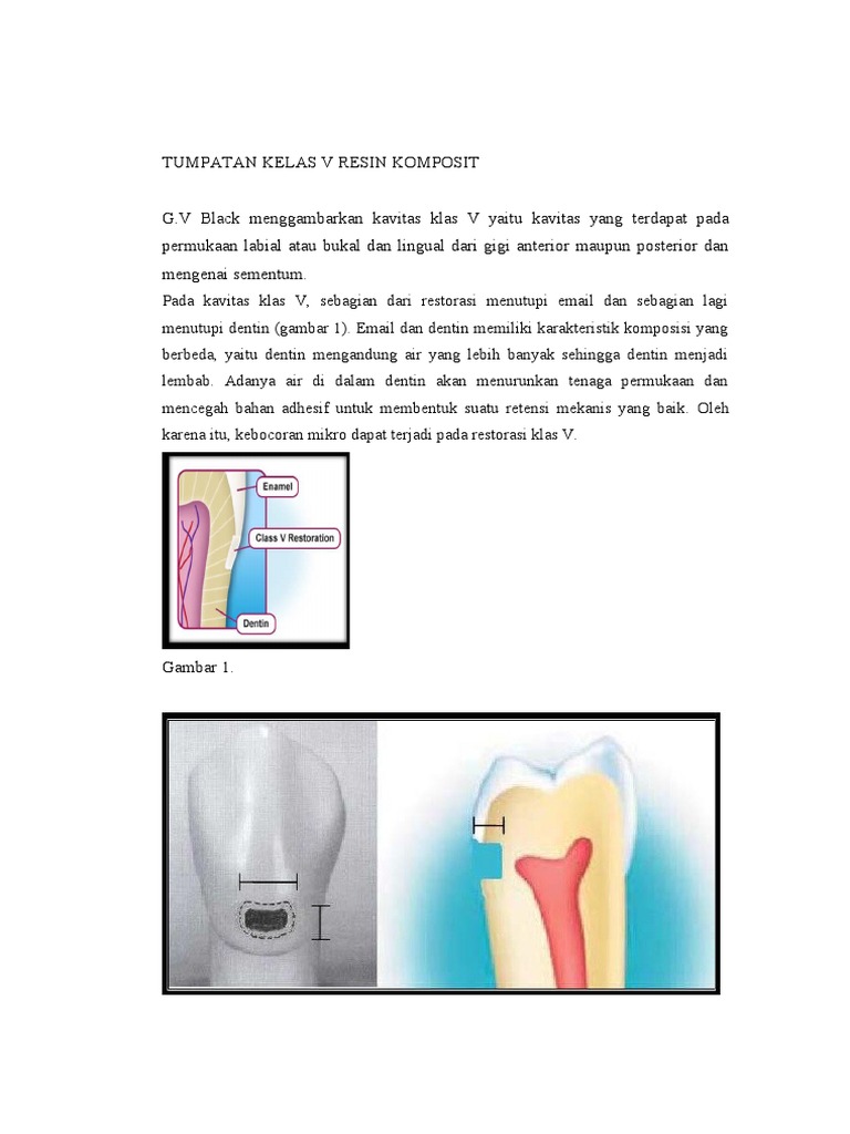 Tumpatan Kelas V Resin Komposit | PDF