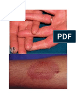 Gambar Dermatitis Kontak Iritan