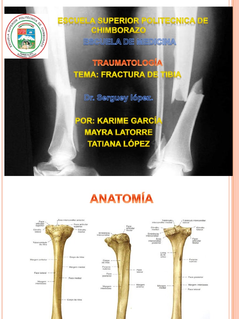Traumatologia Fx Tibia | Rodilla | Sistema musculoesquelético