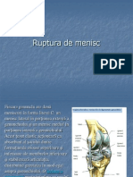 Ruptura de Menisc