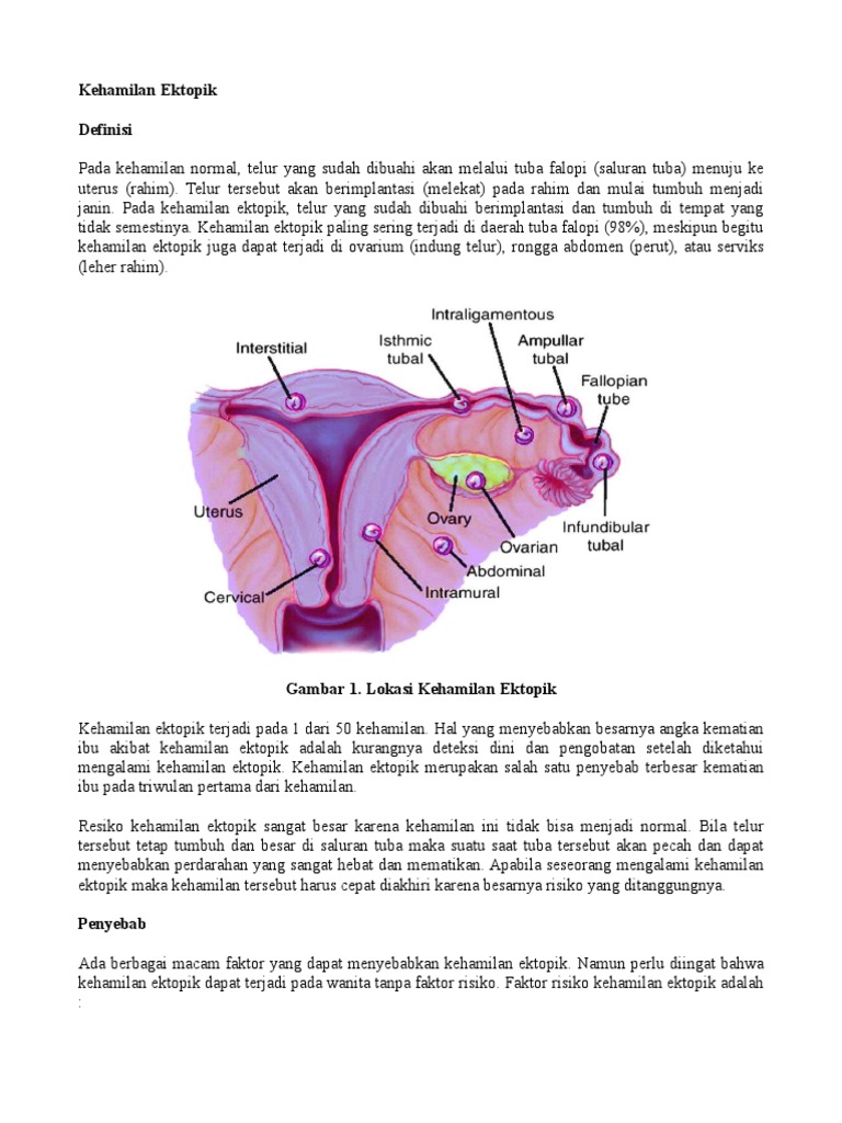 Kehamilan Ektopik | PDF
