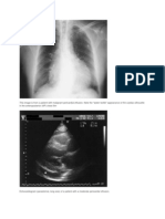 Pericardial Effusion