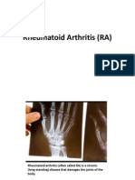 Rheumatoid Arthritis (RA) PD