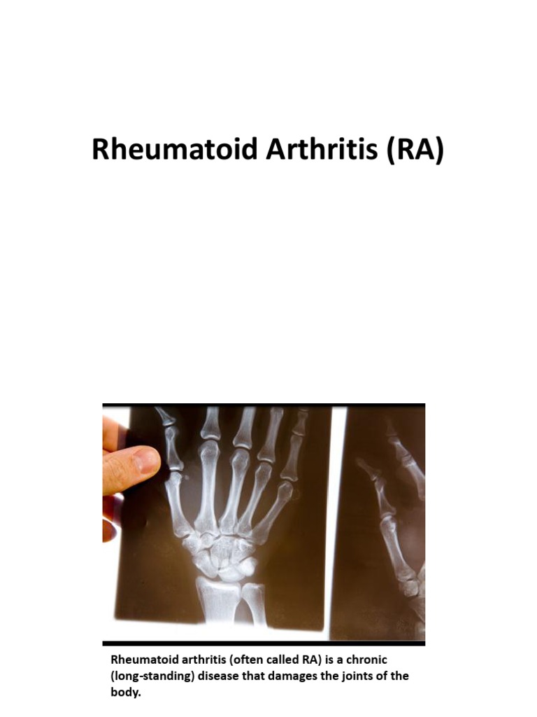 Overview of Rheumatoid Arthritis | PDF | Arthritis | Rheumatoid Arthritis