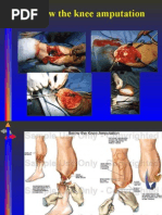 Download Below the Knee Amputation by Darell M Book SN23169608 doc pdf