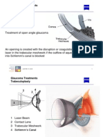 Treatment of Open Angle Glaucoma