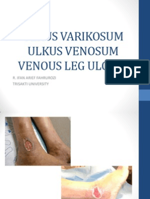 A lábak varikózisának megelőzésére és kezelésére szolgáló eszközök - Bonyodalmak 