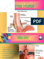 Hernia Hiatal