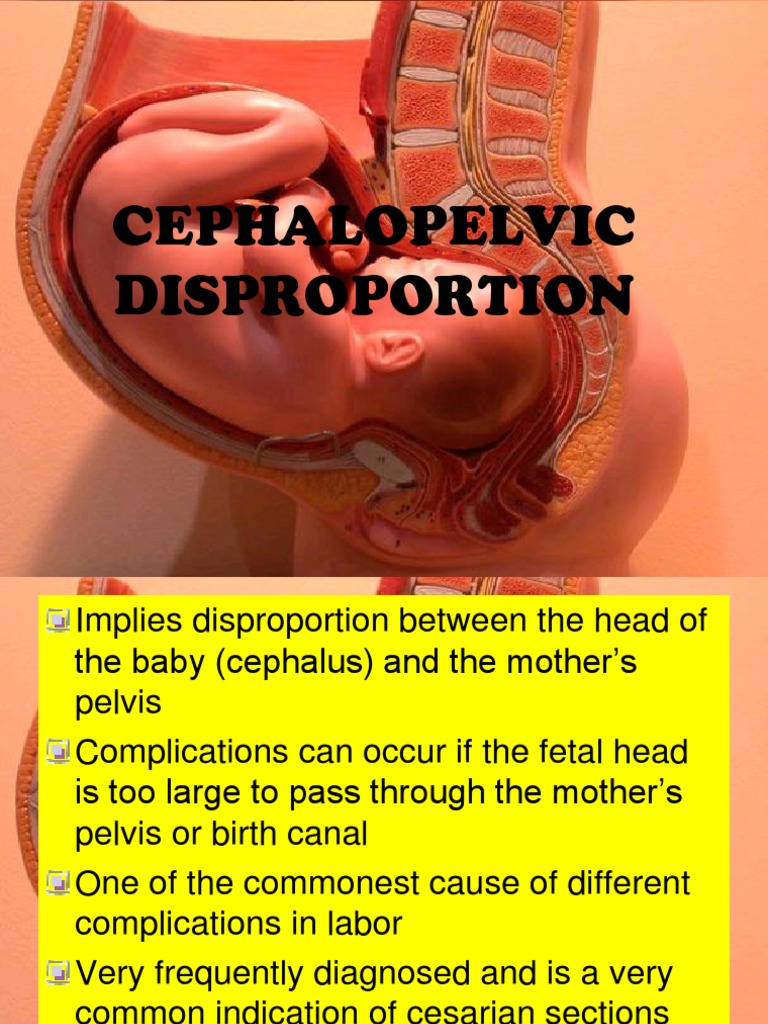 Cephalopelvic Disproportion Pathophysiology