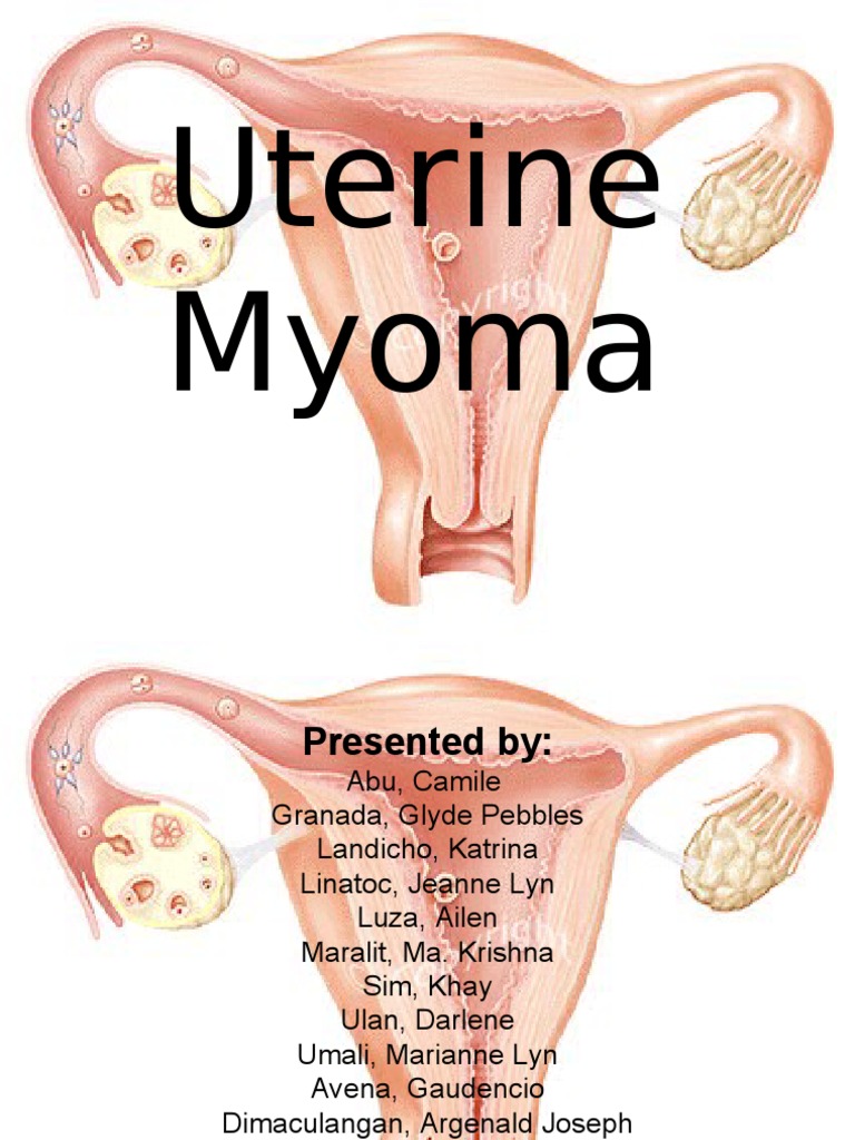 this is it myoma case presentation