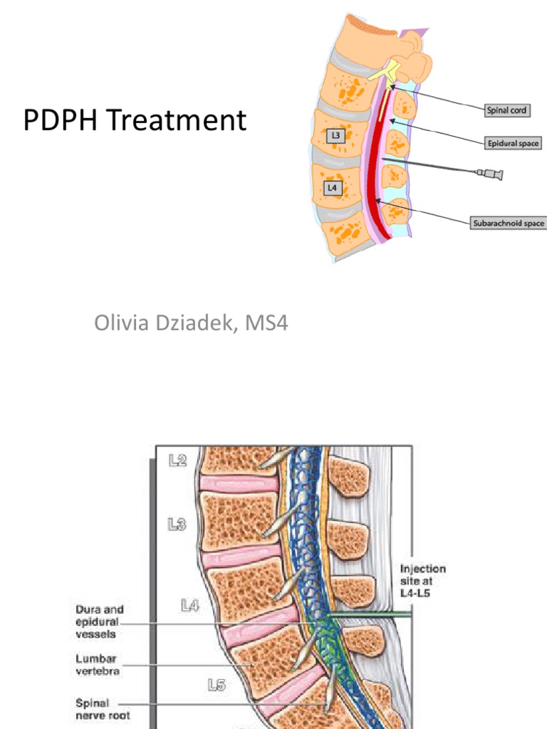 PDPH | PDF | Headache | Medicine