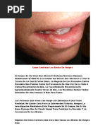 Herpes Labial Remedios Caseros Cura Para Herpes Herpes Labial