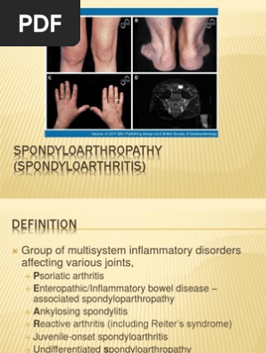Spondylo Arthropathy