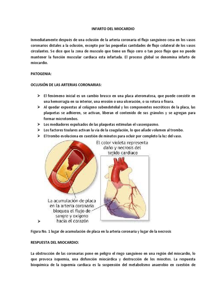 Infarto de Miocardio | PDF | Infarto de miocardio | Circulación coronaria