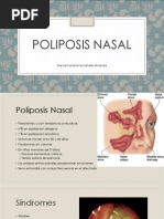 Poliposis Nasal