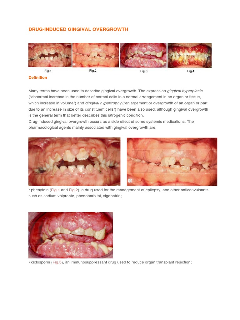 Gingival Overgrowth: Part 2: Management Strategies – VQKICN