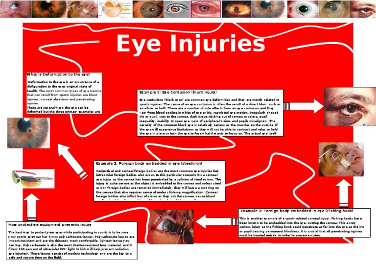 Eye Injuries Poster Cornea Eye