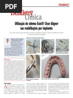 Utilização do Sistema Essix Clear Aligner nas reabilitações por Implantes