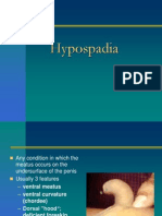 Hypospadias SDC