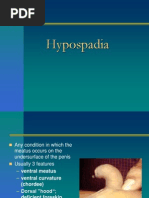 Hypospadias SDC