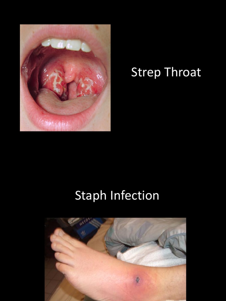 Infection | PDF
