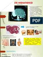 Quiste Hidiatidico