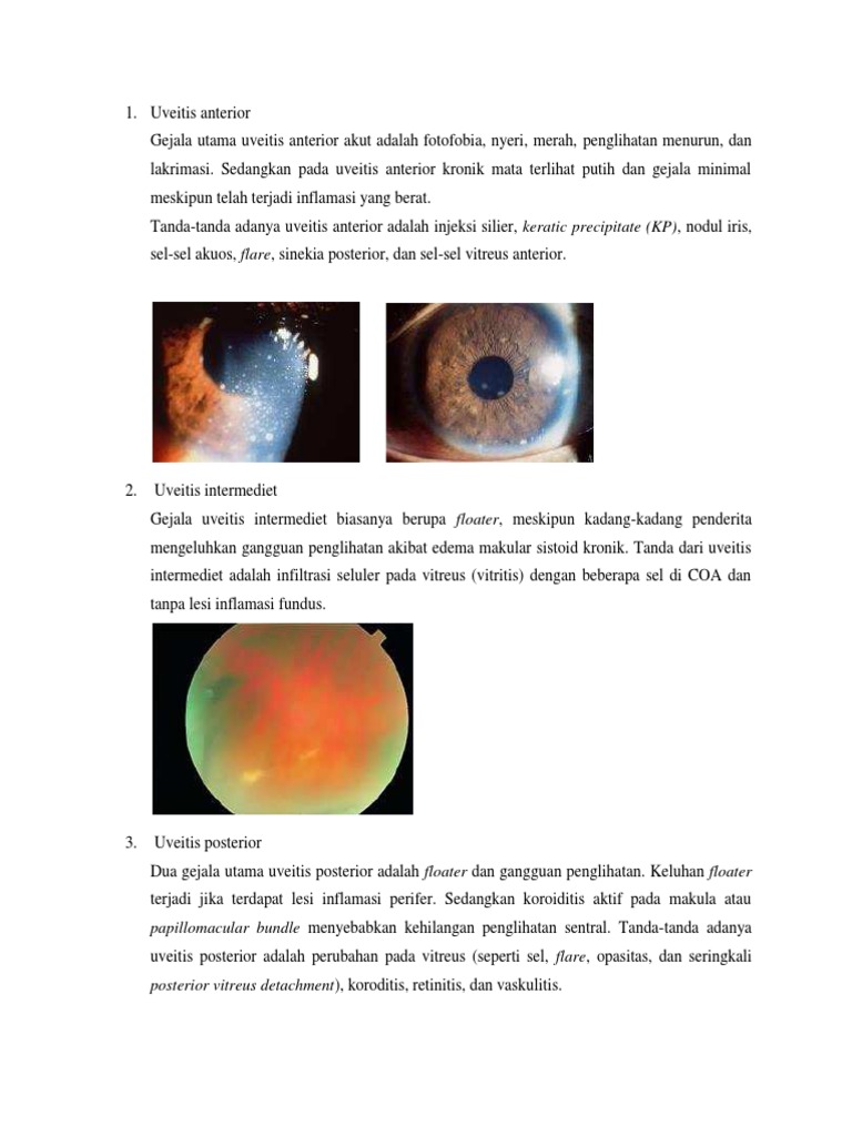 Uveitis Penyakit Peradangan Pada Mata Perawat Mata