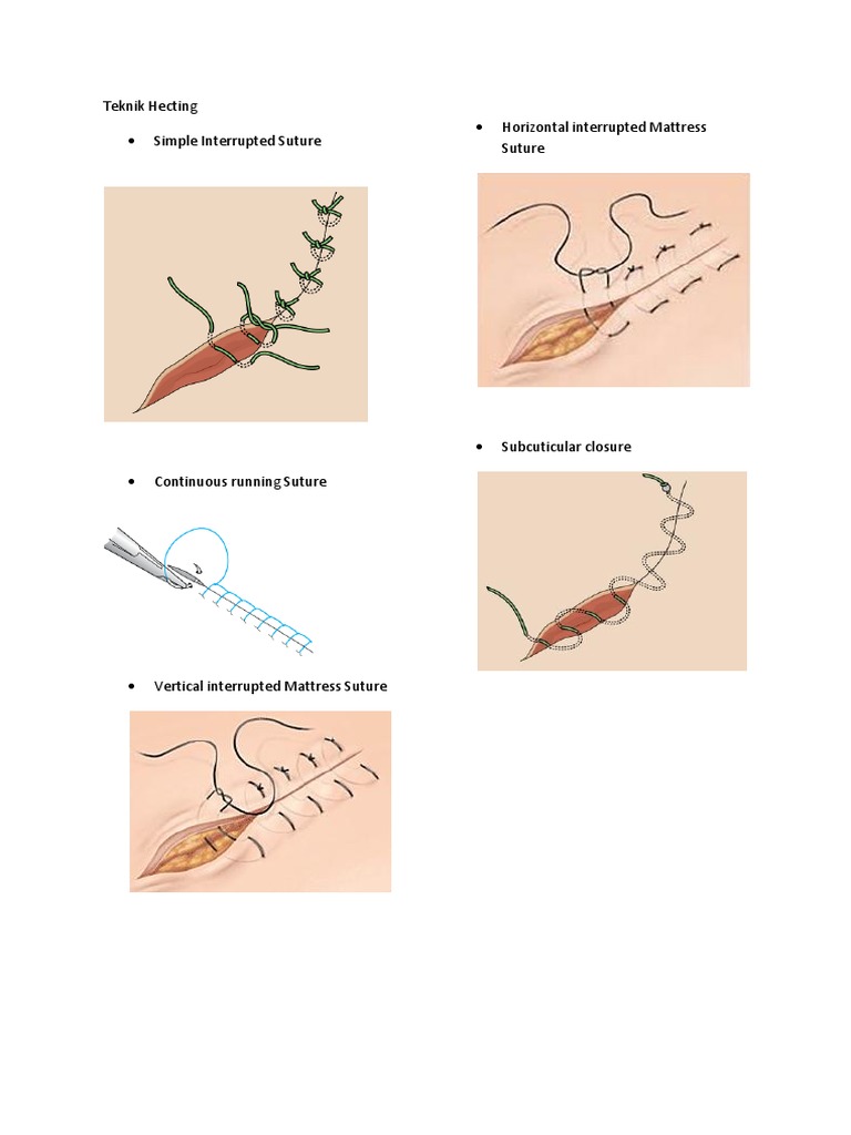Suture Techniques Overview | PDF