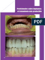 Provisional Es Implant Es