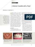 Correction of An Anterior Crossbite With A Fixed Partial Denture